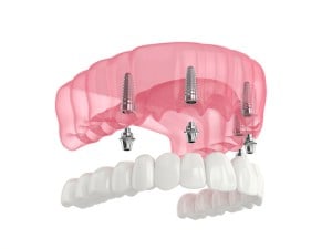 all on 4 dental implants illustration