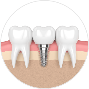 Dental Implants draw