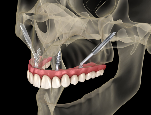 Zygomatic Dental Implants Nashville TN
