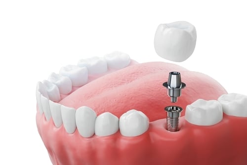 Emergency Dental Implants Nashville TN
