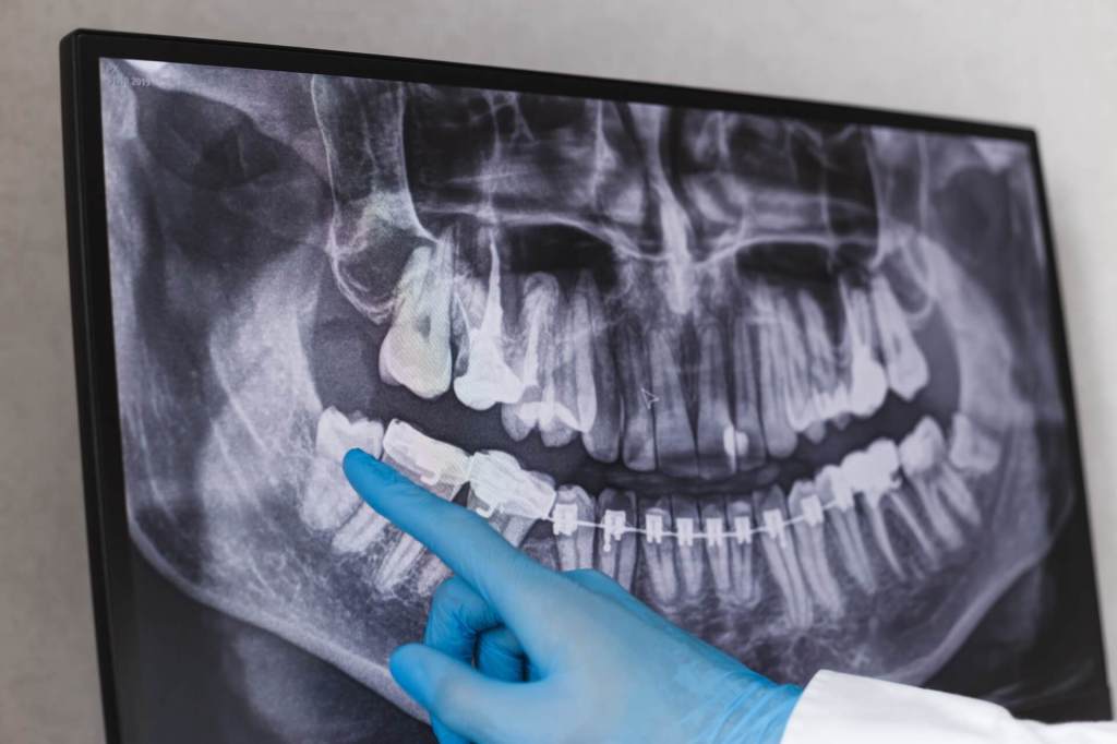 X-Ray Image of Wisdom Teeth