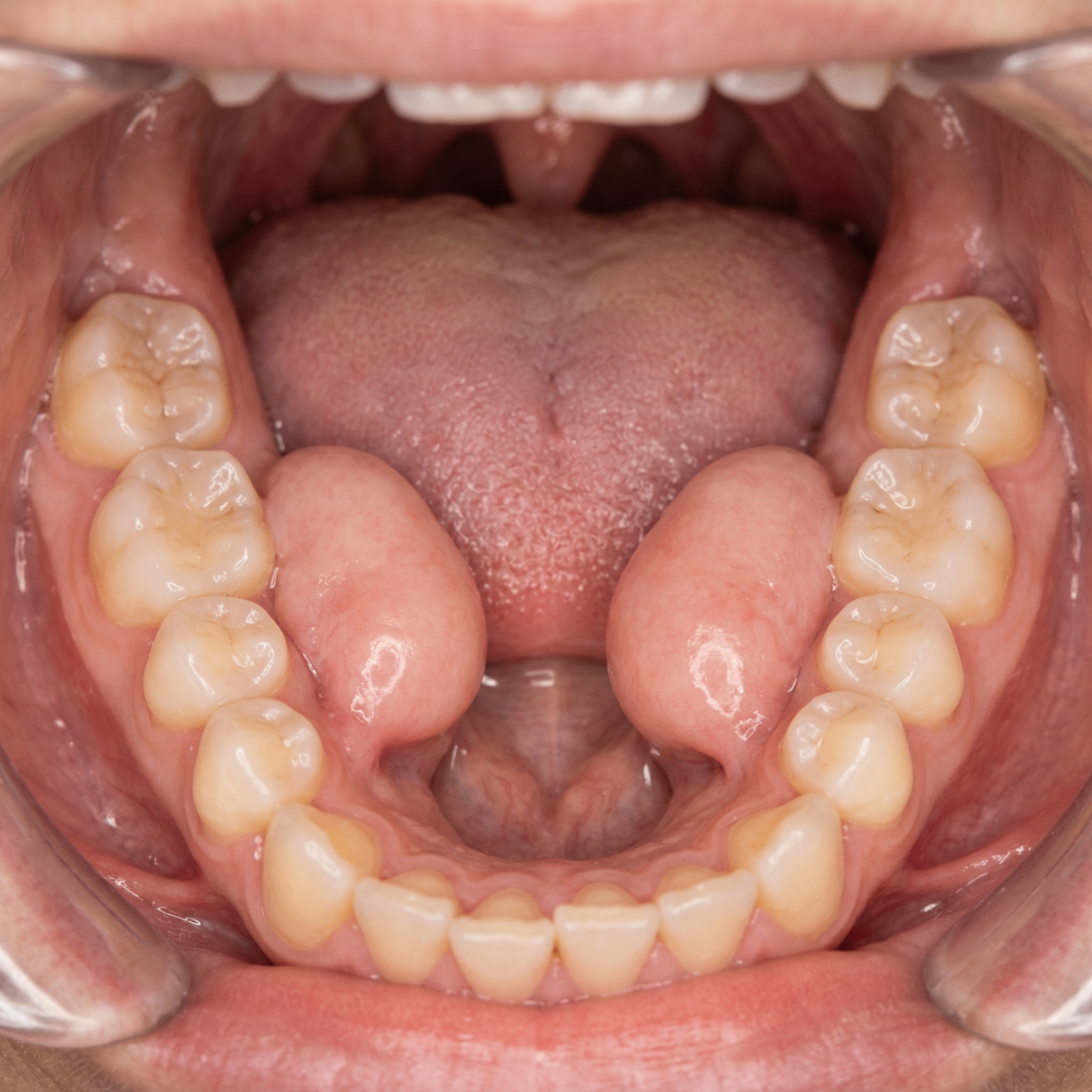 Torus mandibularis bony growths on the inner surface of the lower jaw on both sides of the tongue